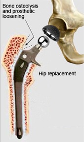 Human prosthetic