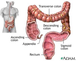 Colon cancer