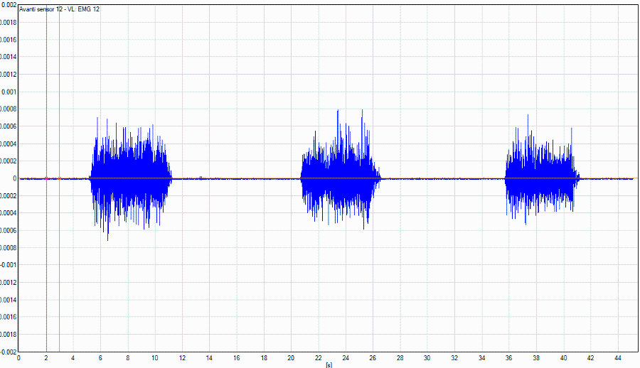 EMG graph showing electrical signals